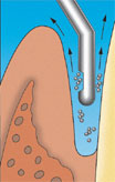 Periodontal Pocket Irrigation