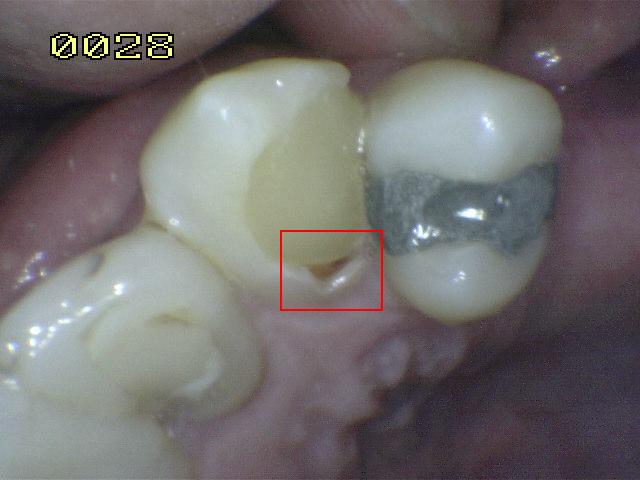 Verfärbt sich grau zahn Zahn verfärbt