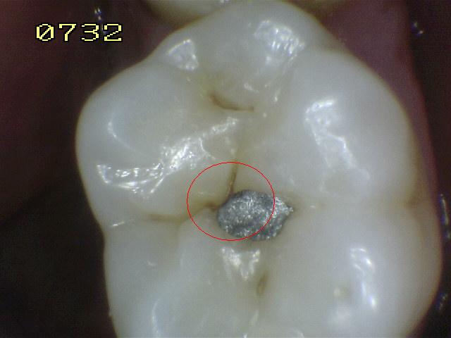 Grau zahn wird ω Zahn