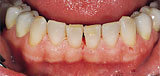 Teeth after treatment with KaVo prophylaxis products