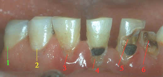 Caries dental, ¿cuáles son sus causas y sus tratamientos?